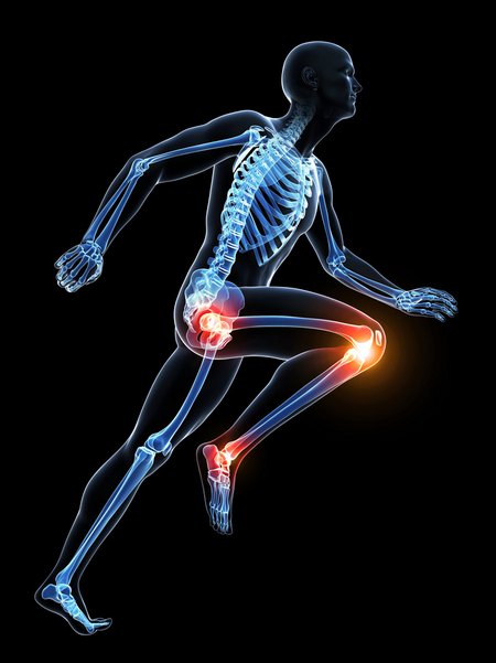 Schaubild zum Gelenkverschleiß und Arthrose bei Hüfte und Knie  