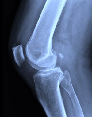 roentgenbild-knie.jpg  
